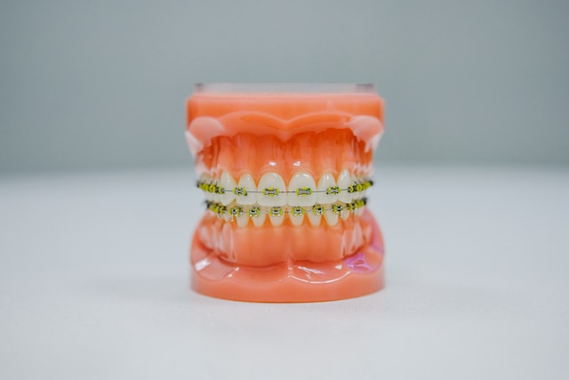 Penasaran Cara Merawat gigi Setelah Pasang Behel Dokter Gigi? Yuk Intip Disini